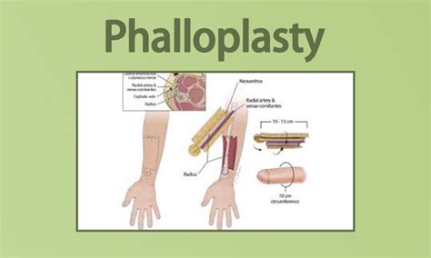 phalloplasty results 2018|Aesthetic Augmentation Phalloplasty: A Systematic Review of.
